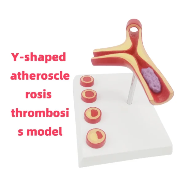 Y-Shaped Artery Atherosclerosis Model with Thrombus PVC Blood Vessel Anatomical Manikin for Medical Science Training Hospitals