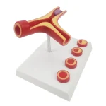 Y-Shaped Artery Atherosclerosis Model with Thrombus PVC Blood Vessel Anatomical Manikin for Medical Science Training Hospitals