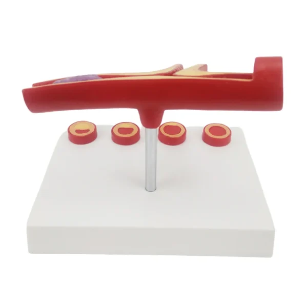 Y-Shaped Artery Atherosclerosis Model with Thrombus PVC Blood Vessel Anatomical Manikin for Medical Science Training Hospitals