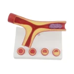 Y-Shaped Artery Atherosclerosis Model with Thrombus PVC Blood Vessel Anatomical Manikin for Medical Science Training Hospitals