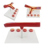 Y-Shaped Artery Atherosclerosis Model with Thrombus PVC Blood Vessel Anatomical Manikin for Medical Science Training Hospitals